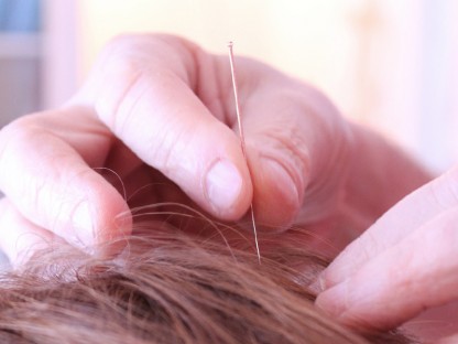 What Is Acupuncture Used for? These 7 Research-Proven Uses Are Just the Start